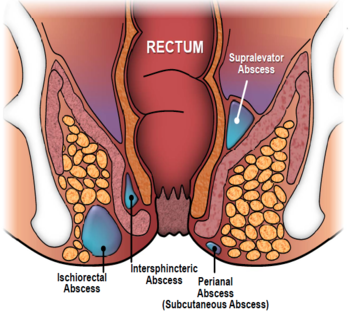 piles doctor in Patna, piles specialist in Patna, proctologist in Patna, best piles doctor in Patna, bawasir doctor in Patna, best homeopathic doctor for piles in Patna, piles surgeon in Patna, bawasir surgeon in Patna, fistula surgeon in Patna, piles specialist doctor in Patna, best fistula surgeon in Patna, best fistula doctor in Patna, Andhra Clinic Patna, Andhra Clinic Masaurhi.