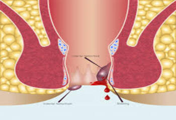 piles doctor in Patna, piles specialist in Patna, proctologist in Patna, best piles doctor in Patna, bawasir doctor in Patna, best homeopathic doctor for piles in Patna, piles surgeon in Patna, bawasir surgeon in Patna, fistula surgeon in Patna, piles specialist doctor in Patna, best fistula surgeon in Patna, best fistula doctor in Patna, Andhra Clinic Patna, Andhra Clinic Masaurhi.