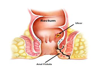 piles doctor in Patna, piles specialist in Patna, proctologist in Patna, best piles doctor in Patna, bawasir doctor in Patna, best homeopathic doctor for piles in Patna, piles surgeon in Patna, bawasir surgeon in Patna, fistula surgeon in Patna, piles specialist doctor in Patna, best fistula surgeon in Patna, best fistula doctor in Patna, Andhra Clinic Patna, Andhra Clinic Masaurhi.